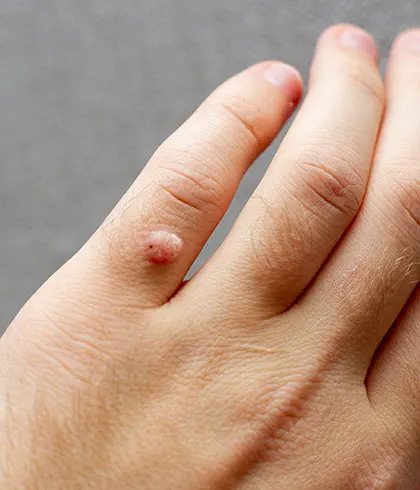 4 Types of Warts and Their Treatment at Dr Batra's®