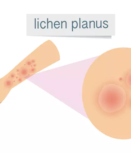 What is Lichen Planus?
