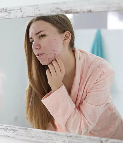 How to treat cystic acne with homeopathy?