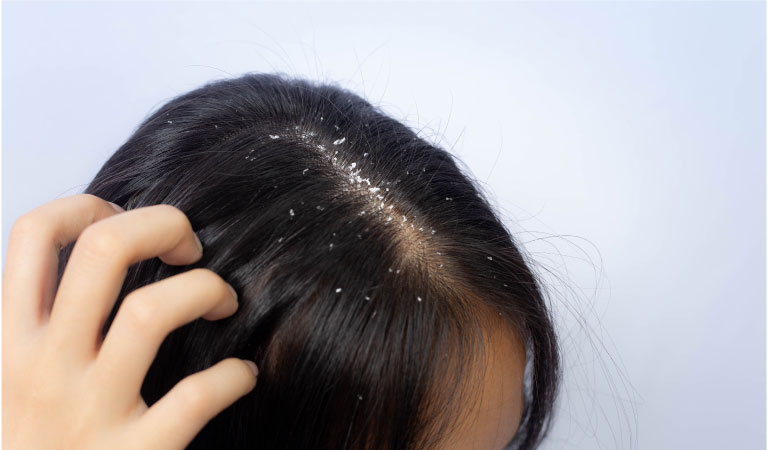 7 Natural Home Remedies for Dandruff and itchy Scalp