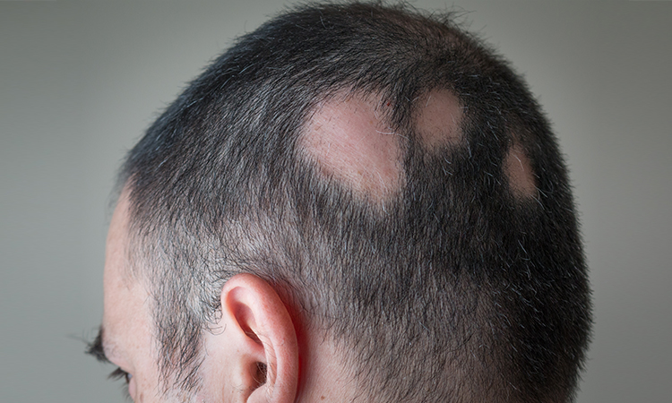 What causes Alopecia Areata in Men