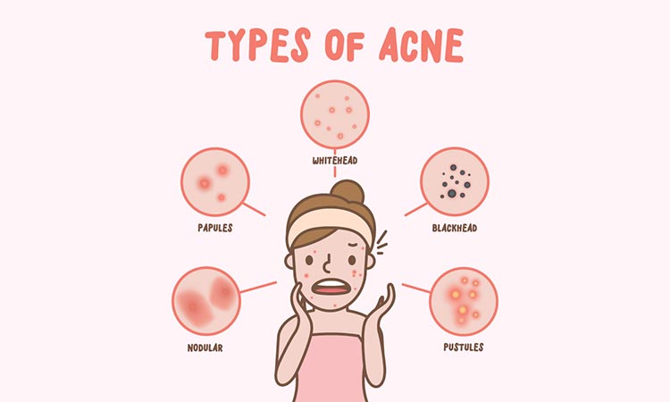 homeopathic-medicine-for-acne_2