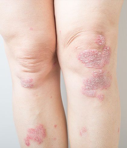 What is Psoriasis and Treatment for Psoriasis & Psoriatic Arthritis?