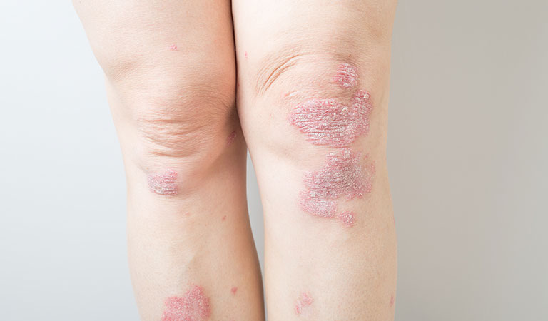 What is Psoriasis and Treatment for Psoriasis & Psoriatic Arthritis?