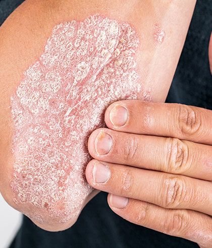 Psoriasis can be treated by Homeopathy
