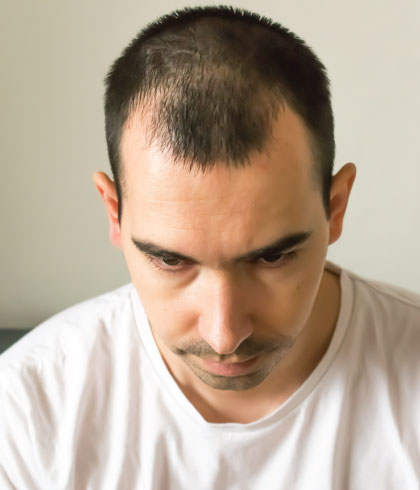 Is genetic hair loss really curable?