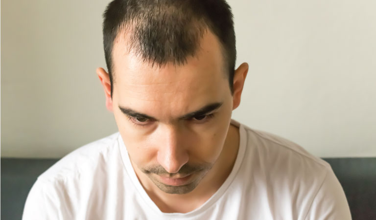 Is genetic hair loss really curable?