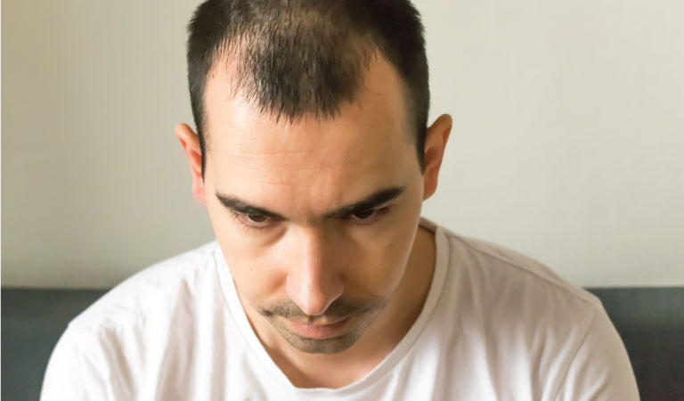 Genetic Hair loss Male pattern BaldnessToppikMalaysia