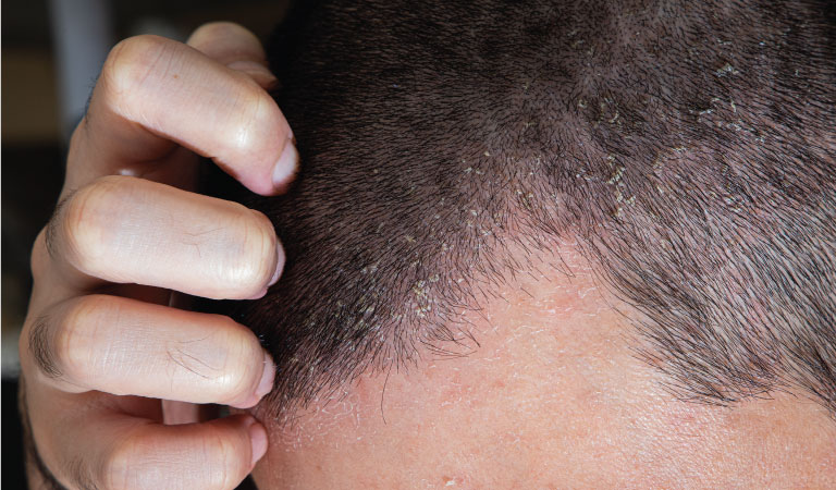 What is The Best Treatment for Scalp Eczema?