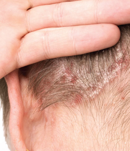 How Does One Reduce Hair Psoriasis?