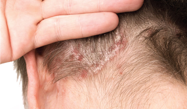 How Does One Reduce Hair Psoriasis?