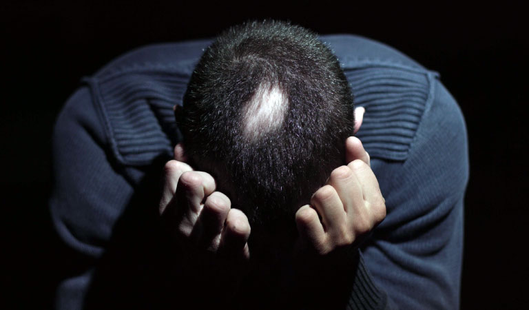 How to Mentally Overcome Alopecia Areata?