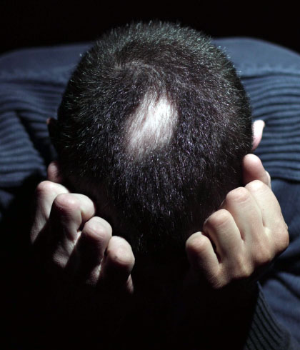 How to Mentally Overcome Alopecia Areata?