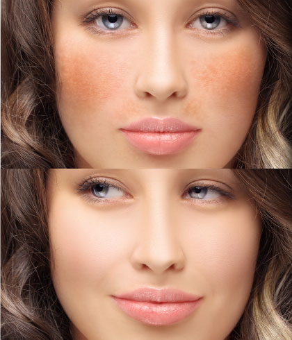 Everything You Need to Know About Hyper-Pigmentation Treatment