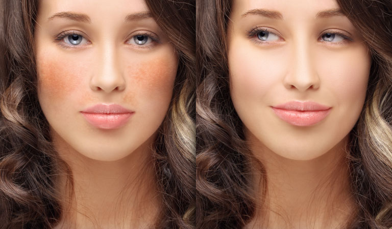 Everything You Need to Know About Hyper-Pigmentation Treatment