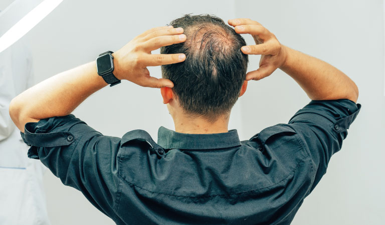 Is Male Pattern Baldness Stoppable?