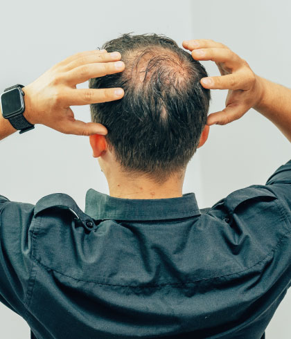 Is Male Pattern Baldness Stoppable?