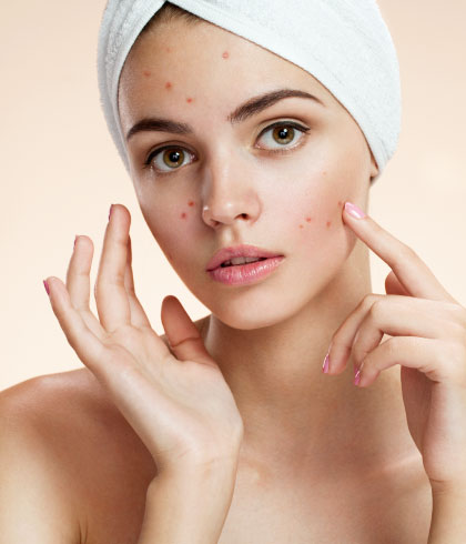 How can one get rid of acne as quickly as possible?