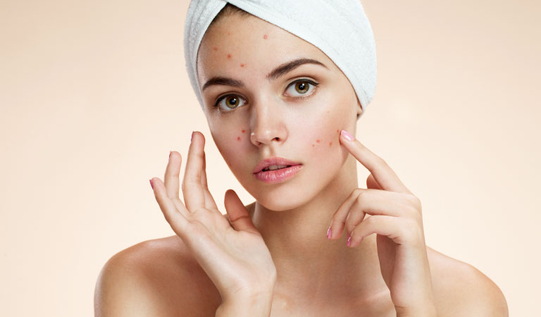 How can one get rid of acne as quickly as possible?