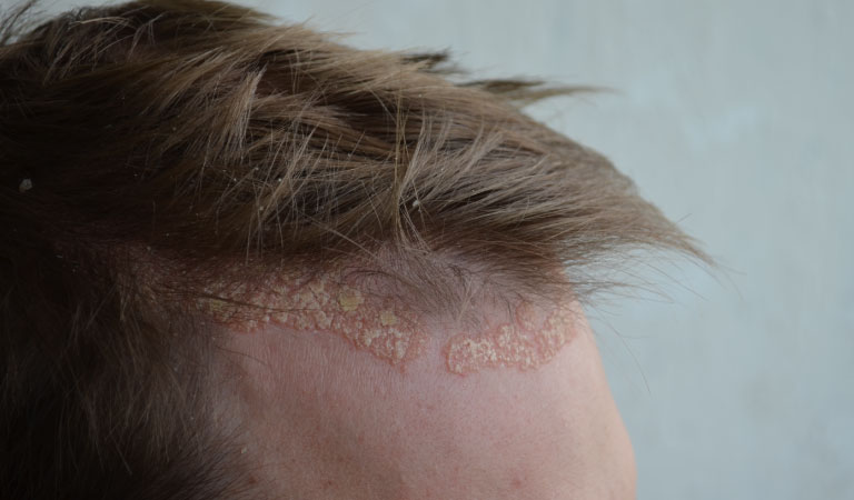 Can Scalp Psoriasis Cause Hair Loss?