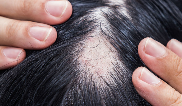 Possible Alopecia Areata Triggers That Affect Men & Women