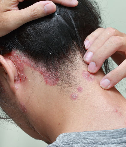 Scalp Psoriasis: Is there any cure for psoriasis in homeopathy