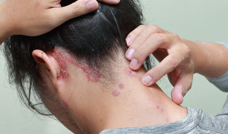 Scalp Psoriasis: Is there any cure for psoriasis in homeopathy