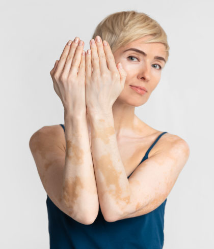 What are the internal and external causes of vitiligo and the best treatment for vitiligo?
