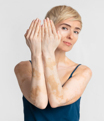 Internal and external causes of vitiligo