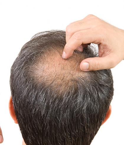 Which vitamin deficiencies can lead to hair fall