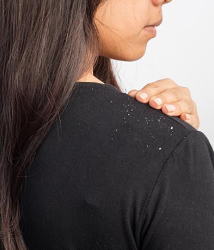 Dandruff vs. Dry Scalp – The Difference and Causes