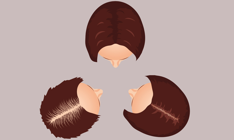 FEMALE PATTERNED BALDNESS