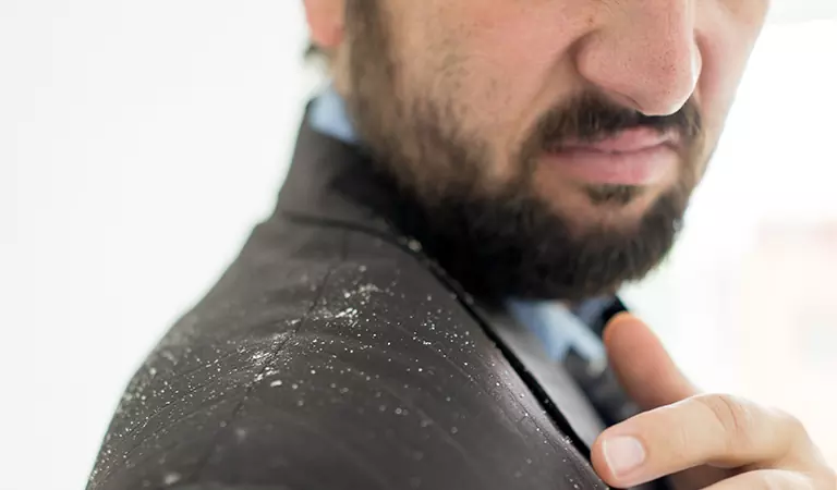 Is Dandruff or Seborrheic Dermatitis Contagious