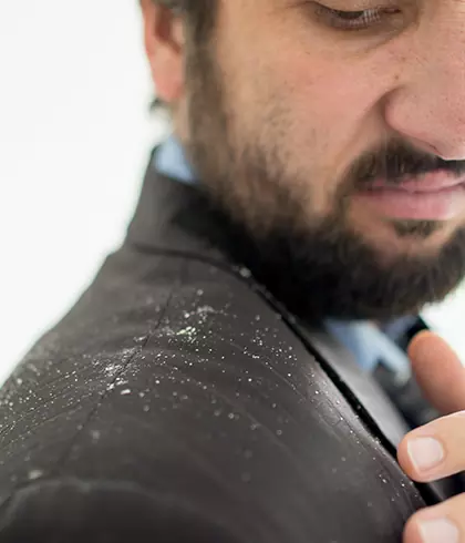 Is Dandruff or Seborrheic Dermatitis Contagious