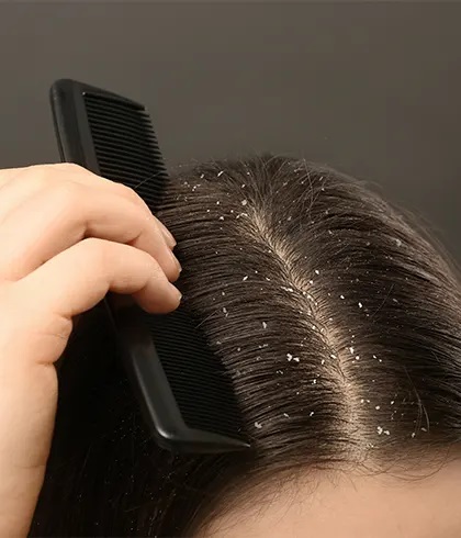 7 Hacks to Get Rid of Dandruff at Home In Winter