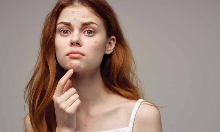 ACNE ON THE BODY? CAN HOMOEOPATHY HELP?