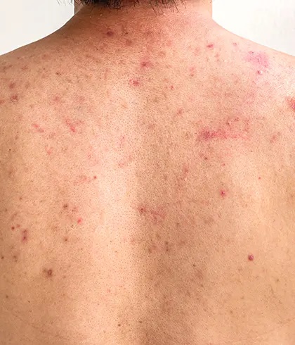 Back Acne Treatment: How to Get Rid of Back Acne?