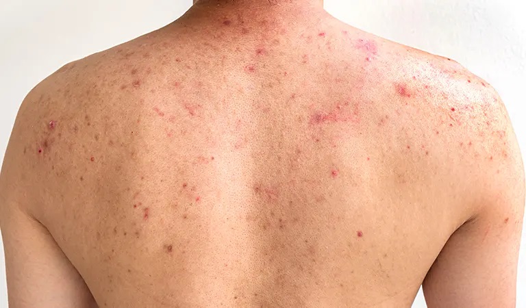 Back Acne Treatment: How to Get Rid of Back Acne?