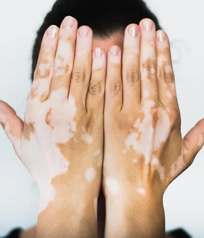 Do's and don'ts for vitiligo skin condition