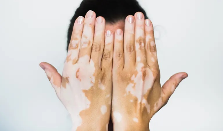 Do's and don'ts for vitiligo skin condition