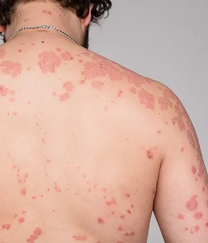 Psoriasis Causes & Treatment: Frequently Asked Questions (FAQ)