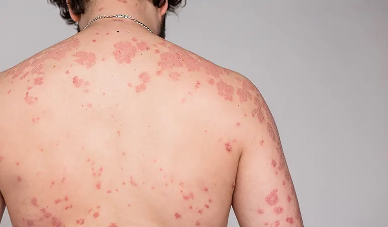 Psoriasis Causes & Treatment: Frequently Asked Questions (FAQ)