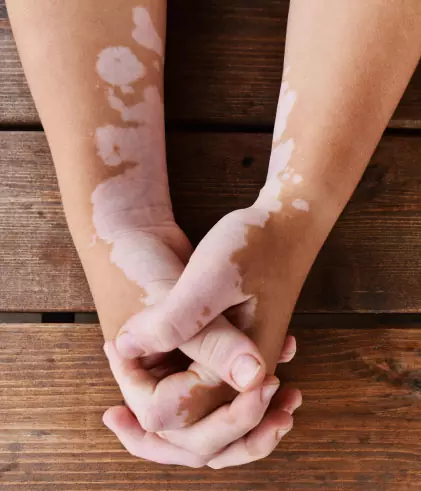 Can Medical Treatment Cure Vitiligo In 30 Days? Find Out!