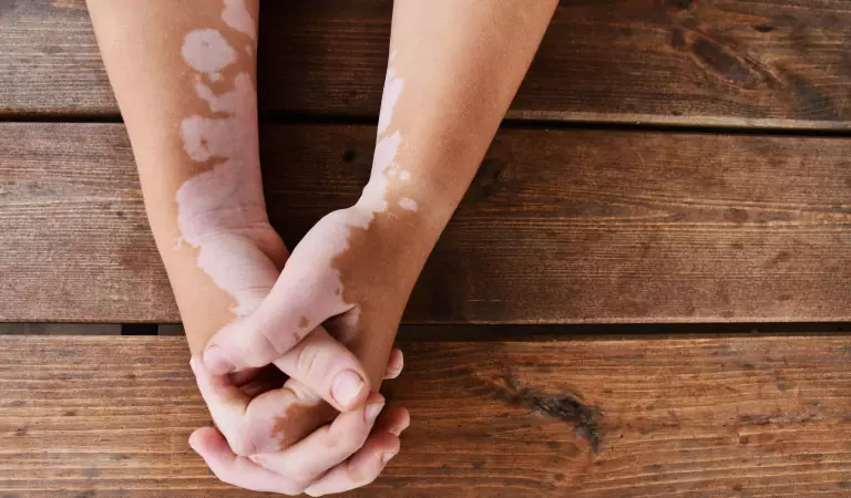 Can Medical Treatment Cure Vitiligo In 30 Days? Find Out!