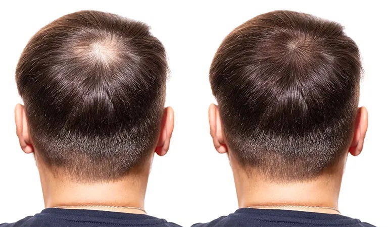 10 Best Ways to Stop Hair Loss final 1 2 حلول لتساقط الشعر والصلع