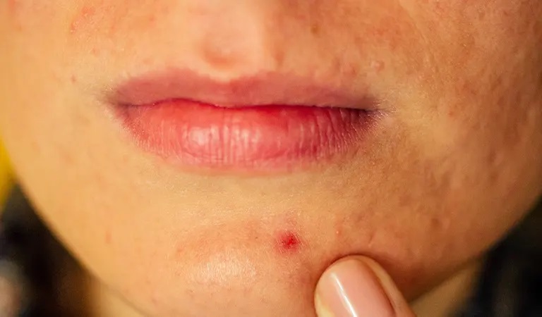 Everything You Need to Know About Treating Hormonal Acne