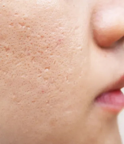 5 Types of Acne Scars: Everything You Need To Know