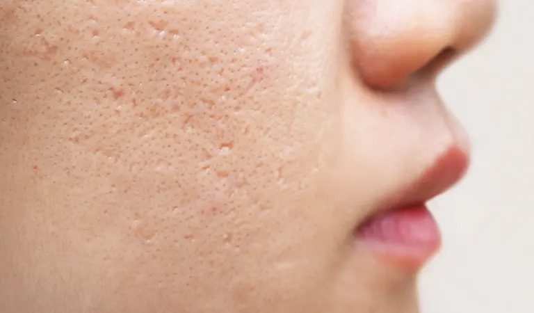 5 Types of Acne Scars: Everything You Need To Know