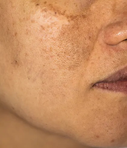 How to Get Rid of Hyperpigmentation Around Mouth?