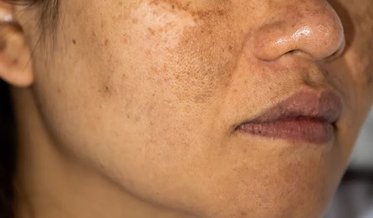 How to Get Rid of Hyperpigmentation Around Mouth?
